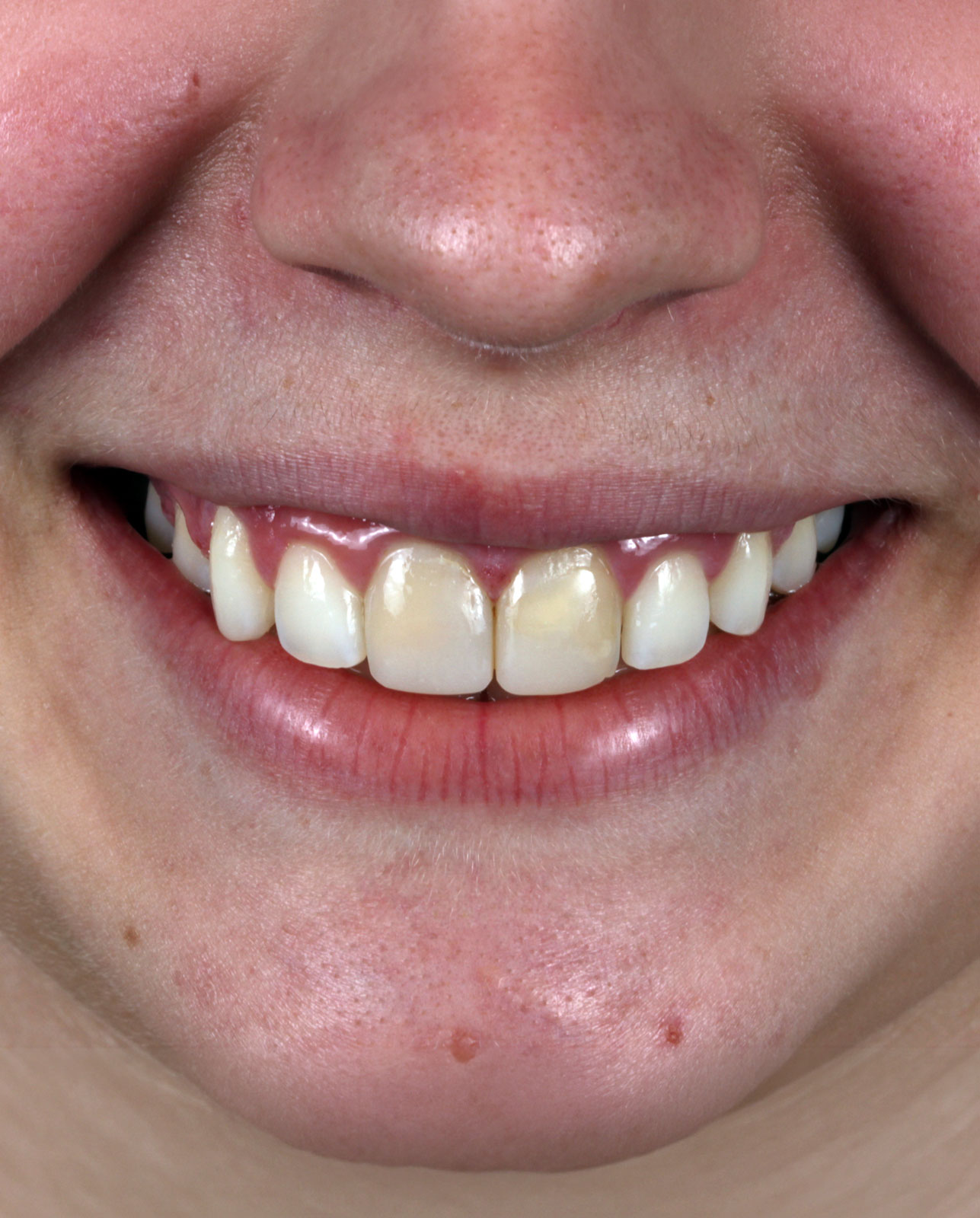 Sorriso antes do tratamento