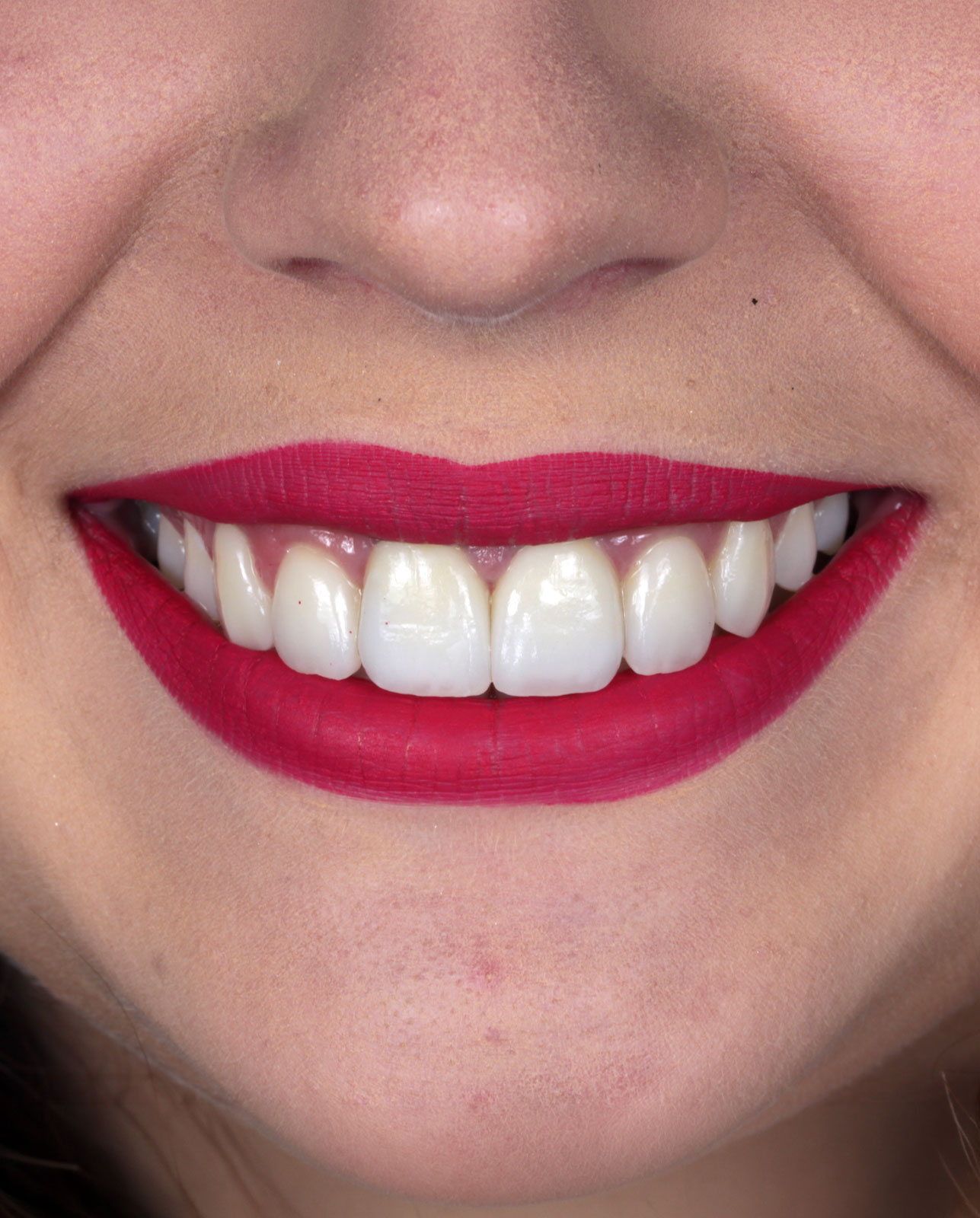 Sorriso depois do tratamento